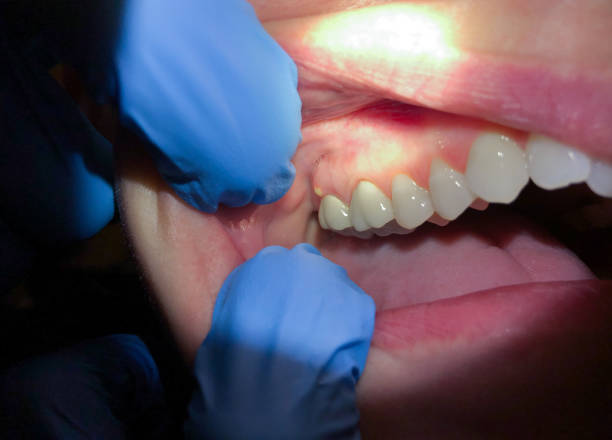 Best Emergency Dentist for Lost Fillings or Crowns in Port Jefferson Station, NY